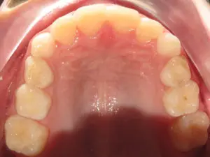 Braces Before and After Pictures Virginia Beach, VA