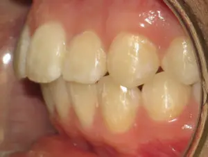 Braces Before and After Pictures Virginia Beach, VA