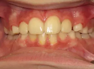 Braces Before and After Pictures Virginia Beach, VA