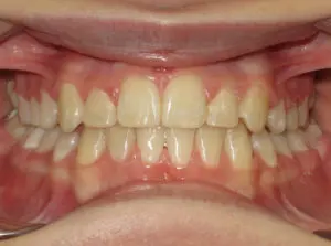 Braces Before and After Pictures Virginia Beach, VA