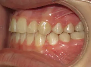 Braces Before and After Pictures Virginia Beach, VA