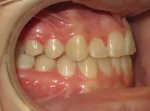 Braces Before and After Pictures Virginia Beach, VA