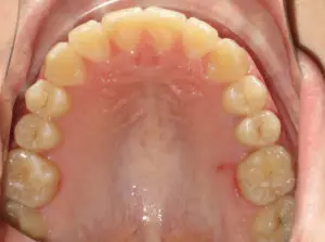 Braces Before and After Pictures Virginia Beach, VA