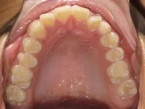 Braces Before and After Pictures Virginia Beach, VA