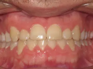 Braces Before and After Pictures Virginia Beach, VA