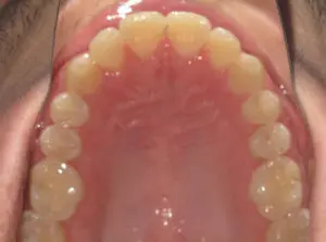 Braces Before and After Pictures Virginia Beach, VA