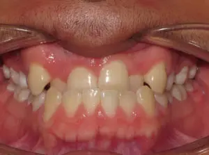 Braces Before and After Pictures Virginia Beach, VA