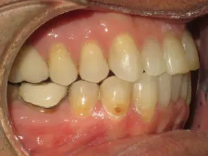 Invisalign Before and After Pictures Virginia Beach, VA