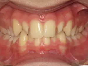 INVISALIGN BEFORE AND AFTER PICTURES IN VIRGINIA BEACH, VA