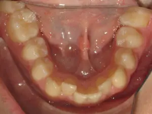 INVISALIGN BEFORE AND AFTER PICTURES IN VIRGINIA BEACH, VA