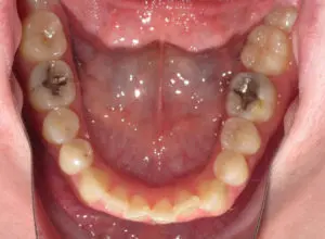 Braces Before and After Pictures Virginia Beach, VA