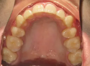 Braces Before and After Pictures Virginia Beach, VA