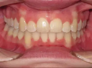 Braces Before and After Pictures Virginia Beach, VA