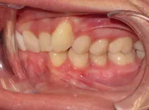 Braces Before and After Pictures Virginia Beach, VA