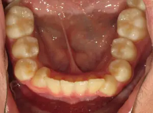 Braces Before and After Pictures Virginia Beach, VA