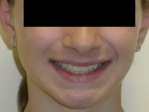 Braces Before and After Pictures in Virginia Beach, VA