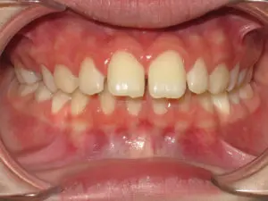 Braces Before and After Pictures in Virginia Beach, VA