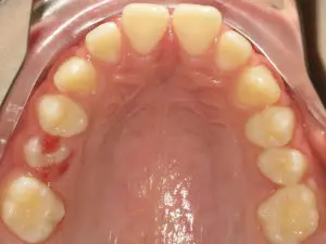 Braces Before and After Pictures in Virginia Beach, VA