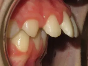 Braces Before and After Pictures in Virginia Beach, VA