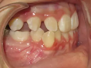 Braces Before and After Pictures in Virginia Beach, VA