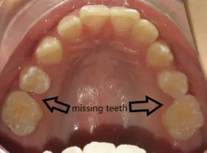 Braces Before and After Pictures in Virginia Beach, VA