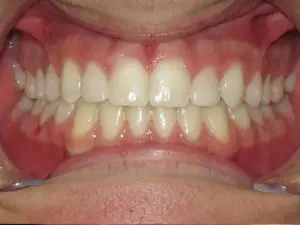 Braces Before and After Pictures Virginia Beach, VA