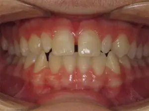 Braces Before and After Pictures Virginia Beach, VA