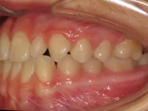 Braces Before and After Pictures Virginia Beach, VA