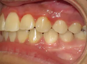 Invisalign Before and After Pictures in Virginia Beach, VA