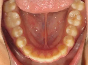 Invisalign Before and After Pictures in Virginia Beach, VA