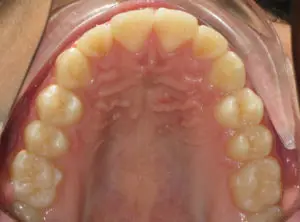 Invisalign Before and After Pictures in Virginia Beach, VA