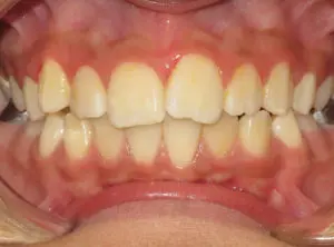 Invisalign Before and After Pictures in Virginia Beach, VA