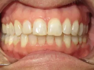 Invisalign Before and After Pictures in Virginia Beach, VA