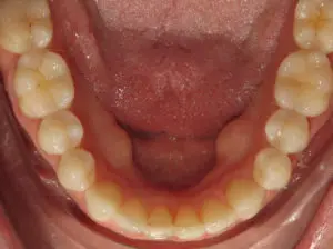 Invisalign Before and After Pictures in Virginia Beach, VA