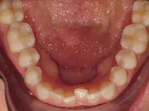 Invisalign Before and After Pictures in Virginia Beach, VA