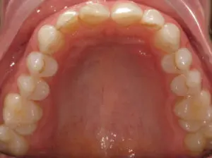 Invisalign Before and After Pictures in Virginia Beach, VA