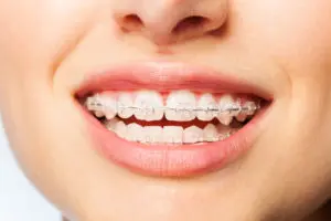Parts of Braces
