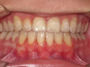 Invisalign Before and After Pictures Virginia Beach, VA