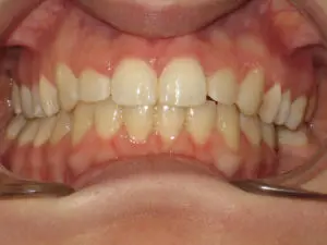 Invisalign Before and After Pictures in Virginia Beach, VA