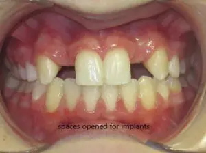 Braces Before and After Pictures in Virginia Beach, VA