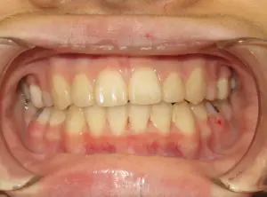 Braces Before and After Pictures in Virginia Beach, VA