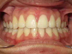 Braces Before and After Pictures Virginia Beach, VA