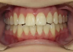 Invisalign Before and After Pictures in Virginia Beach, VA