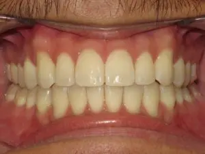 Invisalign Before and After Pictures in Virginia Beach, VA