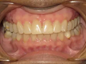 Invisalign Before and After Pictures in Virginia Beach, VA