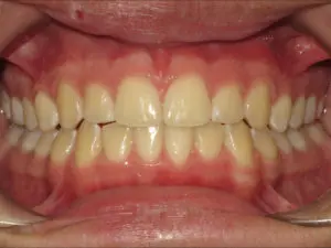 Invisalign Before and After Pictures in Virginia Beach, VA