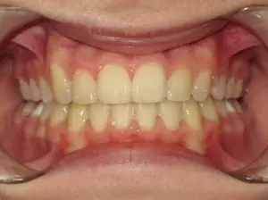 Braces Before and After Pictures in Virginia Beach, VA