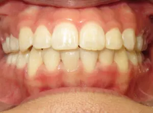 Braces Before and After Pictures Virginia Beach, VA