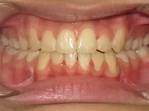 Braces Before and After Pictures Virginia Beach, VA