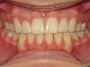 Braces Before and After Pictures in Virginia Beach, VA